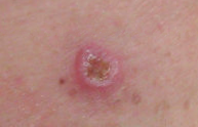 Malignant Melanoma, right posterior thigh (Original Post: Shared in Melanoma)