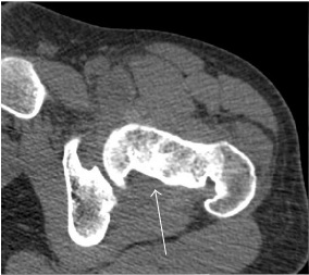 Axial CT image of pigmented villonodular synovitis eroding the posterior cortex of the femoral neck.[1]