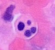 Microscopy of an apoptotic neutrophil with nuclear fragmentation (H&E stain)