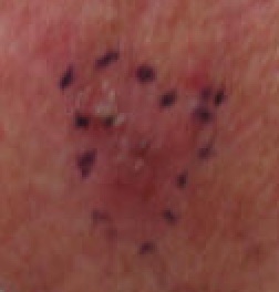 Basal Cell Carcinoma, ulcerated, nodular, on right lower cheek marked for biopsy (Original Post: Shared in Basal-cell carcinoma)