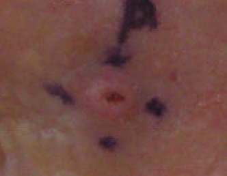 Squamous Cell Carcinoma, left lateral canthus marked for biopsy (Original Post: Shared in Squamous Cell Carcinoma)