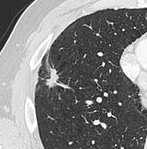 Spiculated lung nodule.[9]