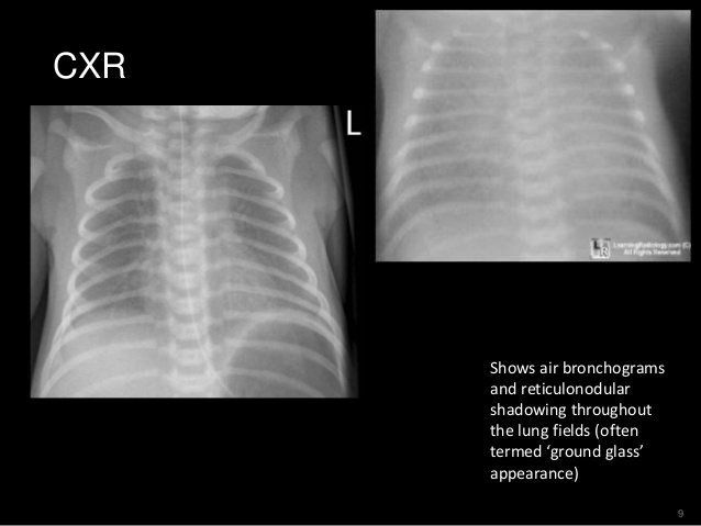 Respiratory distress of the newborn