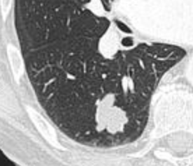 Lobulated nodule.[9]