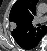 In this case, pleural retraction is seen as a triangular fat component.[9]