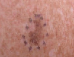 Malignant Melanoma in situ, left anterior shoulder marked for biopsy (Original Post: Shared in Melanoma)