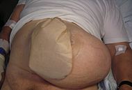 Colostomy and parastomal hernia