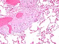 Micrograph of asteroid bodies in pulmonary sarcoidosis. H&E stain.