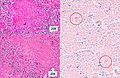 Microscopy, showing epithelioid granulomas with multinucleated giant cells and acid-fast bacilli.