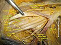 臂叢神經與腋動脈 (1)
