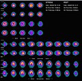 Nuclear medicine myocardial perfusion scan with thallium-201 for the rest images (bottom rows) and Tc-Sestamibi for the stress images (top rows). The nuclear medicine myocardial perfusion scan plays a pivotal role in the non-invasive evaluation of coronary artery disease. The study not only identifies patients with coronary artery disease; it also provides overall prognostic information or overall risk of adverse cardiac events for the patient.