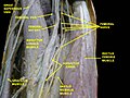 Femoral artery.Deep dissection.