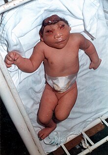 一个患有颅盖缺损和脑部缺损的婴儿