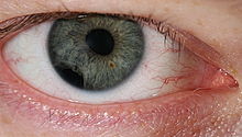 A blue eye shown with iris partially moved into the pupil from the outside edge.