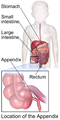 Illustration depicting the location of the appendix in a child