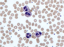 一個核碎裂的細胞包圍在許多比其稍小的紅血球中