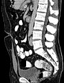 在一位44岁男子的CT 扫描 (sagittal reconstruction) 中，意外发现脐尿管。脐尿管从膀胱向前上方连接到脐正中。