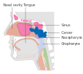 Stage T3 nasopharyngeal cancer