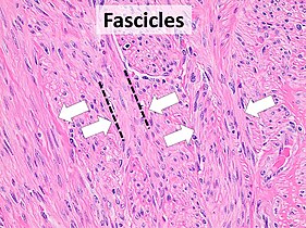 Fascicular: Generally the same cell type throughout, but some form band-like groups that are aligned in the same direction.