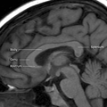 Corpus callosum parts on MRI