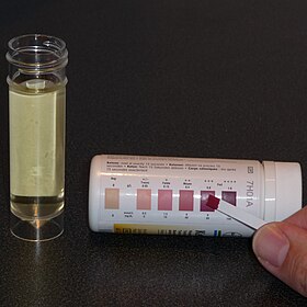 A test strip is compared with a colour chart that indicates the degree of ketonuria