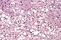 Histological section of a mouse's liver showing severe steatosis. The clear vacuoles contained lipid in life; however, histological fixation caused it to be dissolved and hence only empty/clear spaces are seen.