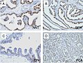 Microscopic examination of different types of prostate tissues (stained with immuno­histochemical techniques): A. Normal (non-neoplastic) prostatic tissue (NNT). B. Benign prostatic hyperplasia. C. High-grade prostatic intraepithelial neoplasia. D. Prostatic adenocarcinoma (PCA).