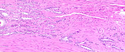 Histology of prostate with gradually increasing simple atrophy from left to right, H&E stain. Crowding and angulation may mimic that of adenocarcinoma, but there is nuclear basophilia rather than atypia, and occasional basal cells can still be seen.