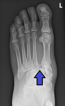 An arrow points to the distance between the proximal ends of the first and second metatarsals, where the Lisfranc ligament has fractured.