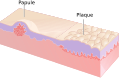 Papule and Plaque