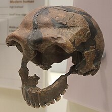 A skull missing most of the left side of the face from the mid-orbit to the teeth