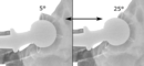 Acetabular anteversion is normally between 5 and 25°.[14] An anteversion below or above this range increases the risk of dislocation.[14] There is an intra-individual variability in this method because the pelvis may be tilted in various degrees in relation to the transverse plane.[14]