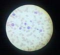 Acute myeloid leukemia