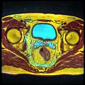 Seminal vesicles seen on an MRI scan through the pelvis. The large cyan-coloured area is the bladder, and the lobulated smaller structures below it are the vesicles.