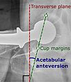 Acetabular anteversion.[89] This parameter is calculated on a lateral radiograph as the angle between the transverse plane and a line going through the (anterior and posterior) margins of the acetabular cup.[89]