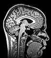 Median plane magnetic resonance imaging of the head.