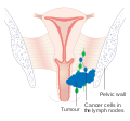 Stage 3 vaginal cancer