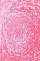 Micrograph showing a thrombus (center of image) within a blood vessel of the placenta. H&E stain.