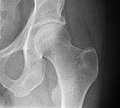 X-ray of the hip joint.