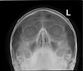 Paranasal sinuses radiograph (occipitomental)