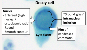 Decoy cells, which are virally infected epithelial cells that may look like carcinoma (Pap stain).