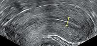 Triple line endometrium