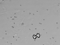 Urine microscopy showing a calcium oxalate monohydrate crystal (dumbbell shaped) and a calcium oxalate dihydrate crystal (envelope shaped) along with several erythrocytes.