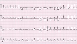 ECG of atrial fibrillation at 132 bpm