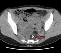 A complex cyst due to a dermoid as seen on CT. Arrow points to bone or teeth.