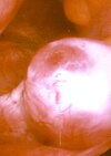 An ovary shortly before an egg is released