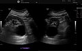 Renal cyst as seen on abdominal ultrasound