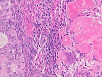 Endometrial adenocarcinoma (carcinoma at left in image) with squamous differentiation evidenced as necrotic “ghost cells” of keratinocytes at right in image, leaving pink keratin as well as clear spaces at the prior locations of the cell nuclei.