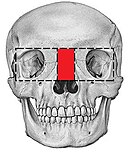 Box osteotomy