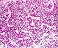 True null cell adenomas are typically composed of uniform, mildly atypical cells with chromophobic cytoplasm. This case has papillary architecture similar to gonadotroph adenomas.[59]